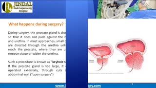 Transurethral Resection of the Prostate (TURP) Surgery in Kota