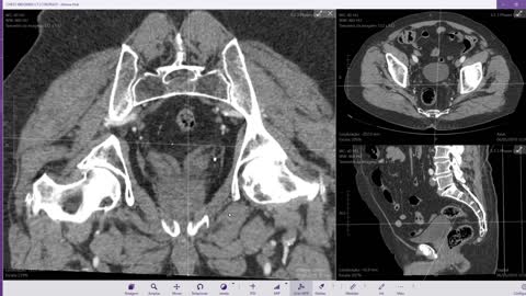 Anatomia Radiológica: VESÍCULAS SEMINAIS