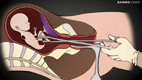 What is Abortion? How are Abortions Performed? True Facts about this Barbaric “Contraception”