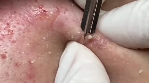 Cleaning blackheads and pimples. 4