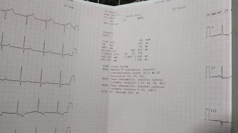 ECG (Electro Cardio graph /Electro cardio gram) #ECG #cardio #medical #health #MI #arreset
