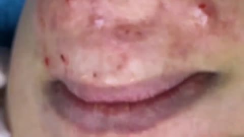 Giants Deep Blackheads, Whiteheads, Big Pimples, Hidden Acne Removal - Best Popping Videos #000040