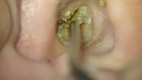 Ear Wax Removal - HIGH DEF