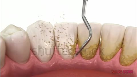 #Dental scaling teeth animation