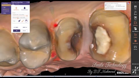 #design #naildesign #dental #dentaldesign #exocadexpert