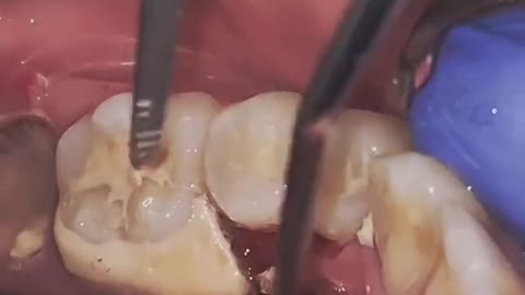 Do you routinely get scaling ? #satisfyingvideo