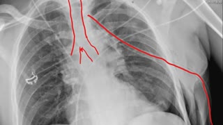 CXR tension pneumothorax