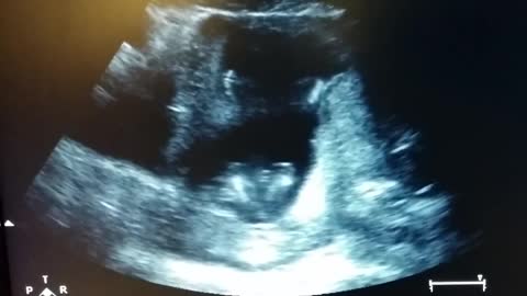 Baby clapping hands in the womb