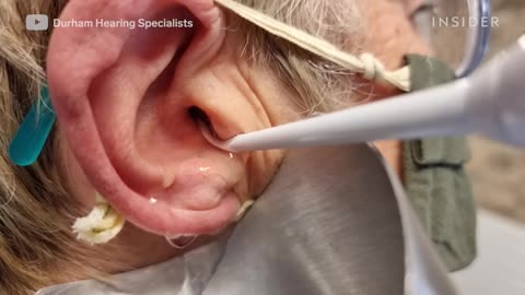 How Earwax Is Professionally Deep Cleaned Deep Cleaned