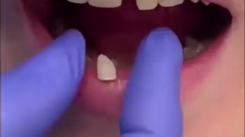 _tiktok _video _dentist _fyp _viral _foryou _love _broken _teeth _blogger_dental