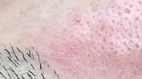 Giants Deep Blackheads, Whiteheads, Big Pimples, Hidden Acne Removal - Best Popping Videos #000016
