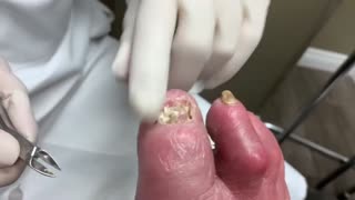 How Thick Nail Cutting On Patient Out Of Body Experience