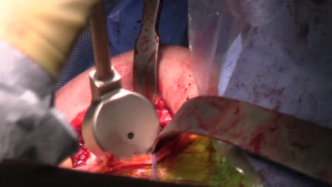 SHOULDER HEMIARTHROPLASTY