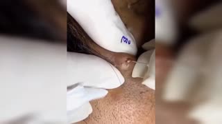 dr pimple popper,drpimplepopper,pimple popping,pimple