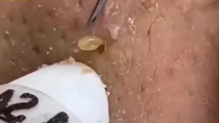 7 minute zit popping