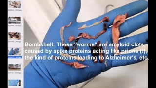 Bombshell insight: Giant rubbery "blood clots" composed of amyloids (dementia alert)