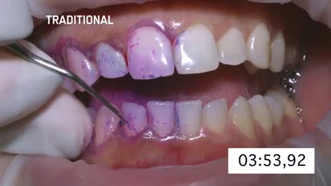Lighthouse Dental Care - EMS Air Flow vs Traditional Cleaning Method