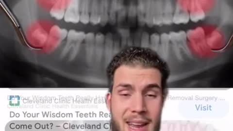 The truth on why they remove the wisdom teeth