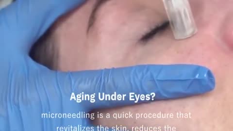 Microneedling services in Edmonton | Oxyderm laser clinic