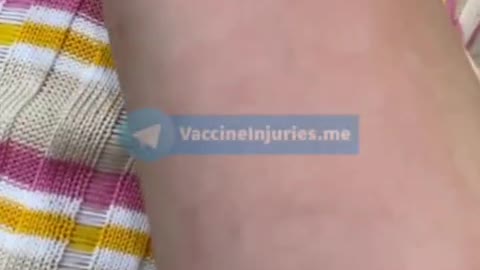 Moderna Vaccine Reaction