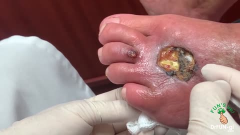 This Is What Happens When A Poisonous Spider Bites Your Foot!!