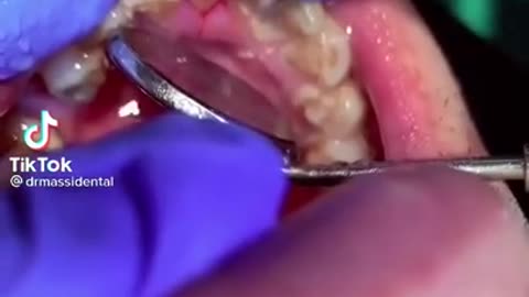 Tartar Dentist 2021 | Satisfying Dental-work