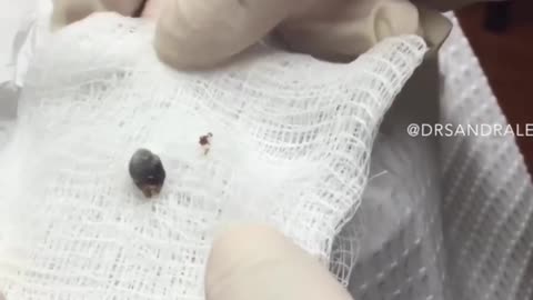 85 Year Old Blackhead! Dr Pimple Popper Most Popular Pop of ALL TIME