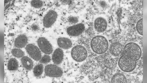 “Immense Frustration”: Monkeypox Spreads Amid Slow U.S. Response; WHO Declares Emergency