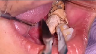 TARTAR removal from teeth.