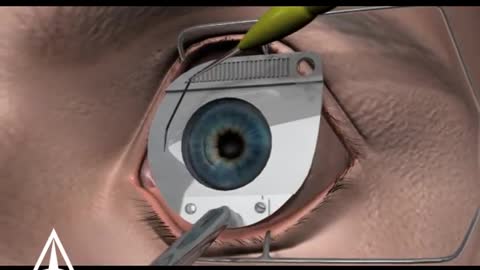 Eye laser surgery 3D
