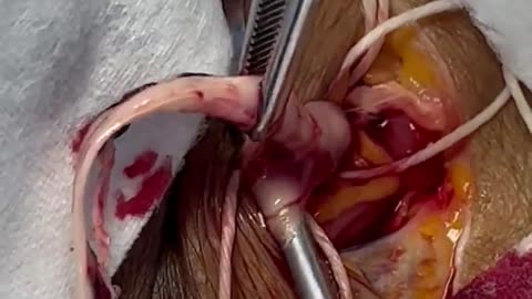 WATCH: Covid-19 Side Effect - A strange white fibrous clot is removed from the right jugular vein