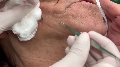 Leprechaun Blackheads