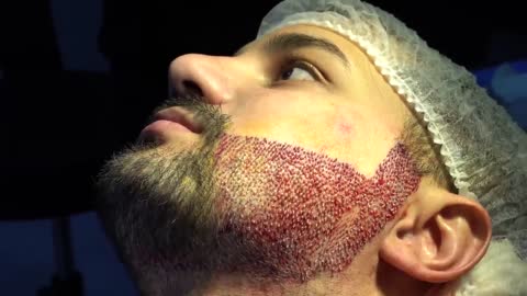 FUE Surgery: Beard Transplant Amazing Results [Before-After]