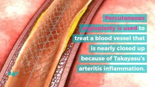 How To Treat And Cope With Takayasu's Arteritis