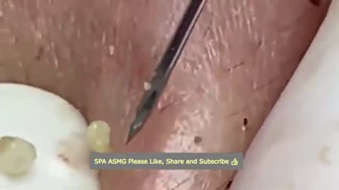 Big blackhead removal/Acne treatment