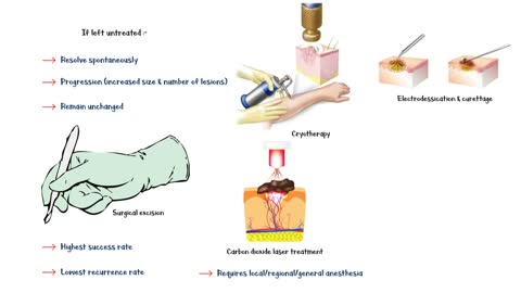 Genital Warts - Causes, Risk Factors, Signs & Symptoms, Treatment