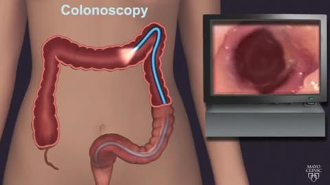 New test to 'eradicate' colon cancer