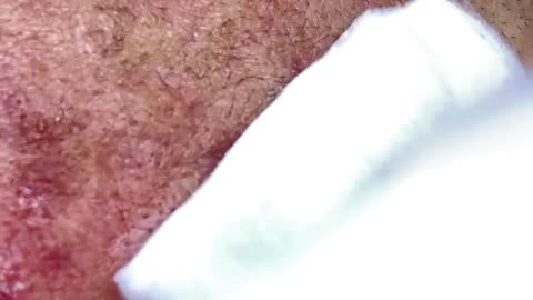 Big_Cystic_Acne_Blackheads_Extraction_Blackheads_&_Milia__Whiteheads_Removal_Pimple_Popping