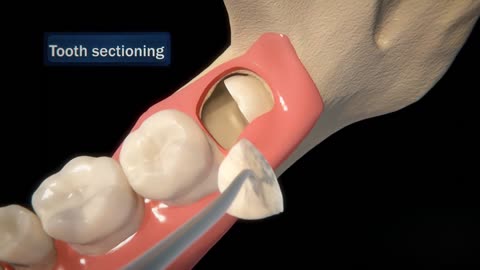 Why wisdom teeth should be extracted step by step process.