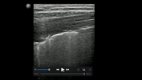Ultrasound pneumothorax