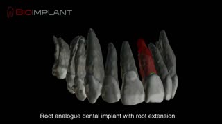 CAD/CAM PLANNING OF A TWO-PIECE ROOT-ANALOG CERAMIC DENTAL IMPLANT WITH ROOT EXTENSION***.