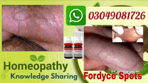 Fordyce spots homeopathic treatments, risk factors, causes and symptoms in hindi