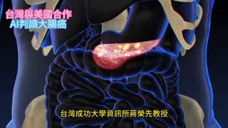 台灣與美國合作 AI判讀大腸癌