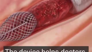 This device removes large blood clots