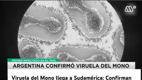 Viruela del Mono llega a Sudamérica: Confirman caso en Argentina