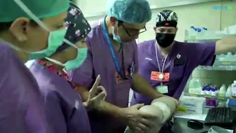 Israeli doctors separate conjoined twin girls