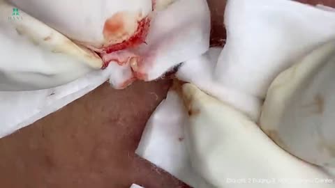 Big cystic acne blackheads removal