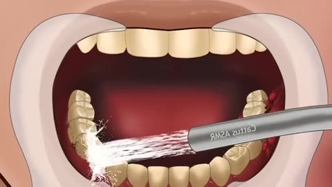 ASMR Treatment of Severe Tooth Decay