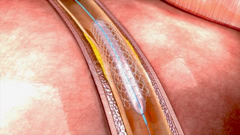 Intravenous catheterization process