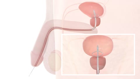 Flat Medical UroAid-IV urinary catheter - 3D medical animation